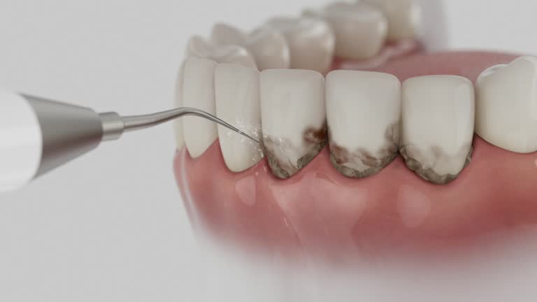 Reliable Wisdom Tooth Removal contractor in Pasadena, CA by Smile Center Dentistry